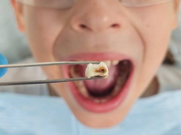 Best Emergency Dental Extractions in Bayshore Gardens, FL